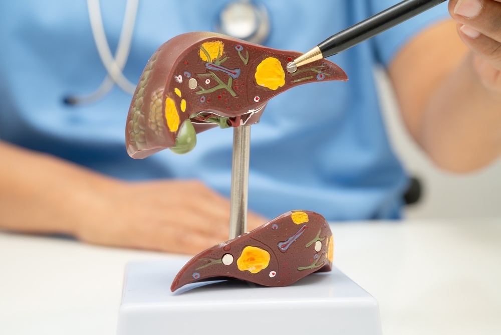 Brasil é um dos países com maior incidência de esteatose hepática do mundo