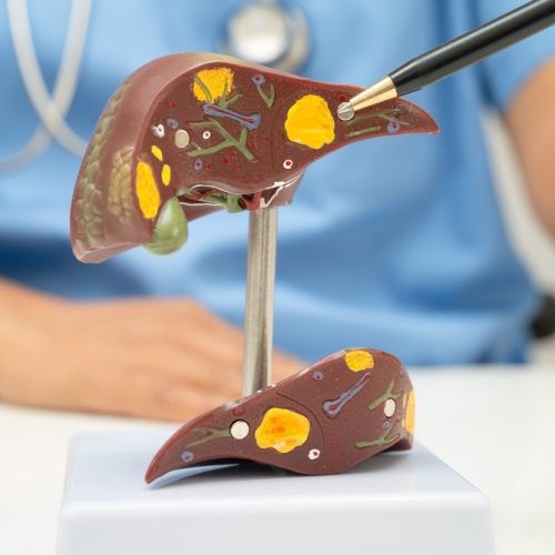 Brasil é um dos países com maior incidência de esteatose hepática do mundo